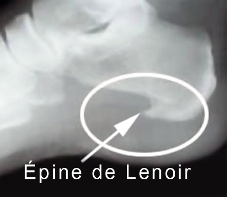 Épine de Lenoir et shockwave