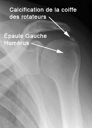 Calcification coiffe des rotateurs