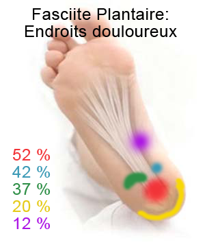 Symptômes de la fasciite plantaire