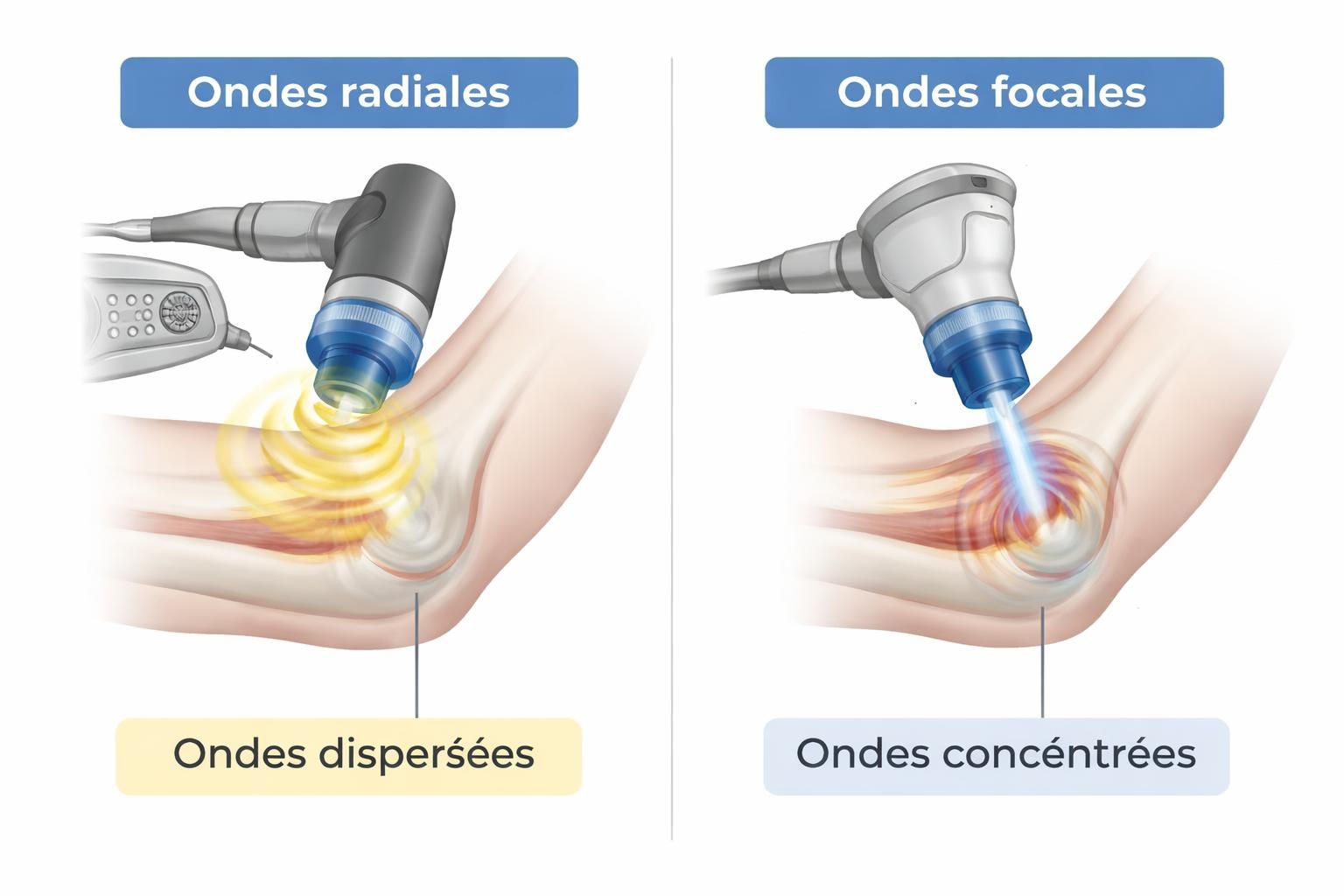 découvrez le traitement par ondes de choc à repentigny pour soulager rapidement et efficacement la douleur au coude. une solution innovante pour retrouver votre mobilité et votre confort.